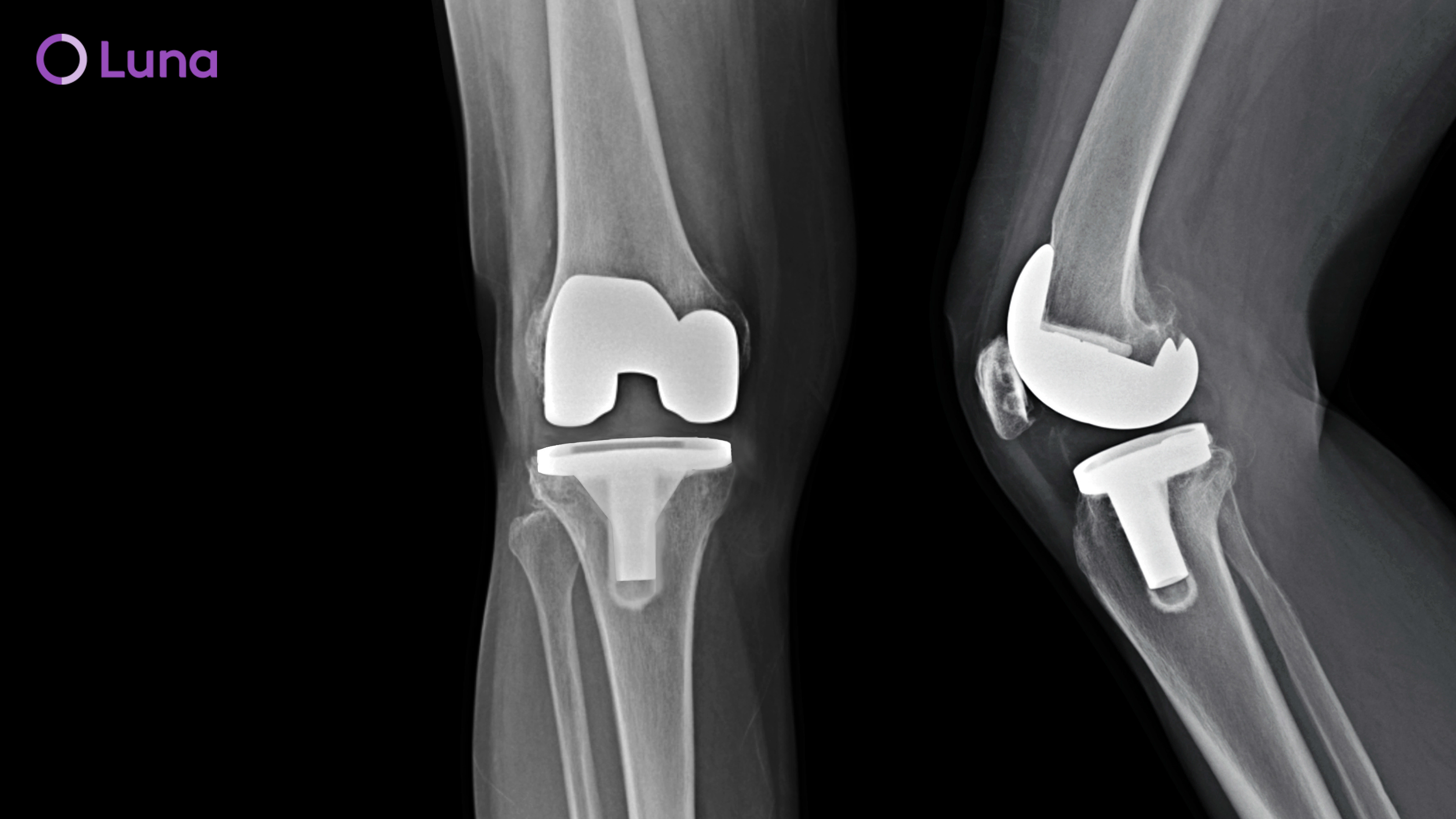 minimally-invasive-hip-replacement-recovery-time-finger-joint